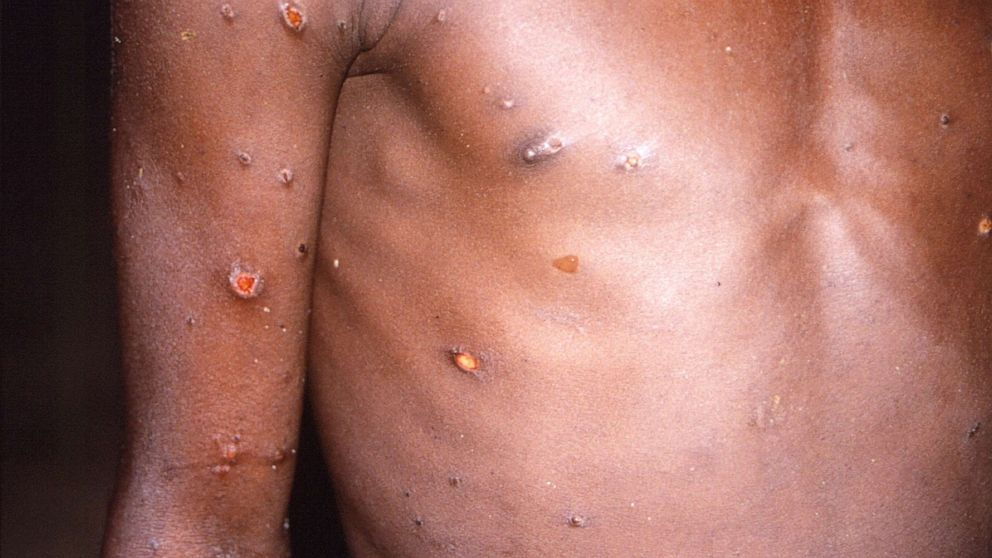 monkeypox symtoms.png